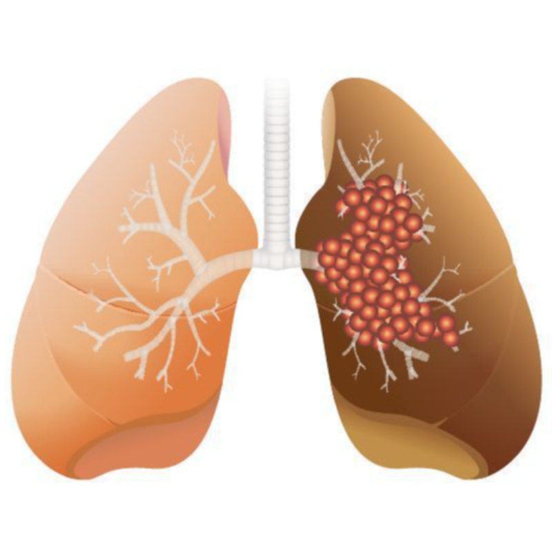 Eine hohe NMN -Dosis hemmt das Wachstum des Lungenadenokarzinoms